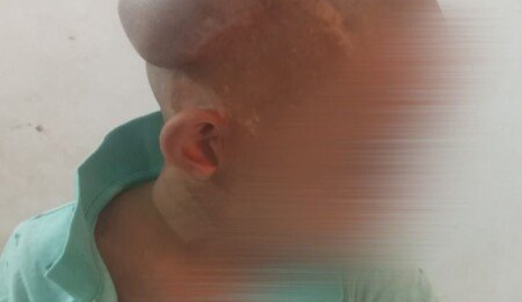 Récolte pour opération enfant brûlé