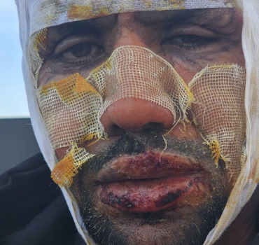 Mohammed grand brûlé au Maroc à besoin d’aide