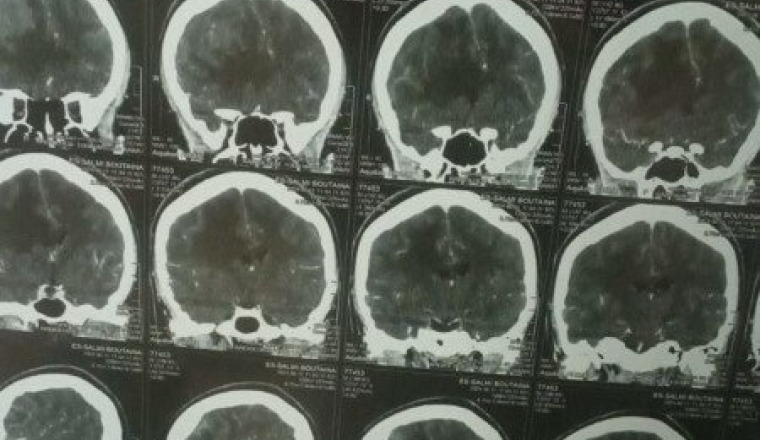 Mlle ES SALMI  atteinte d’une tumeur des méninges