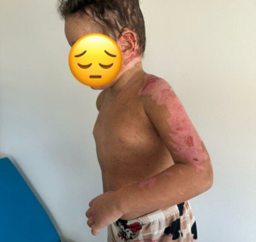 Aidons Aya à soigner ses brulures