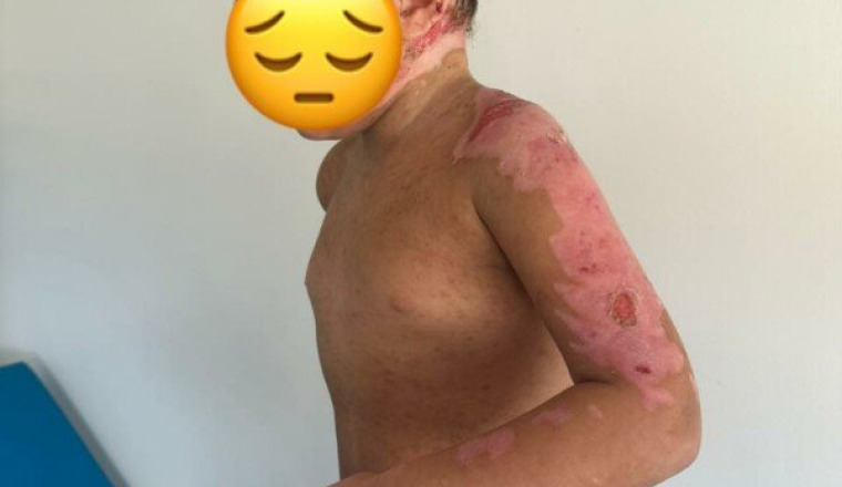 Aidons Aya à soigner ses brulures