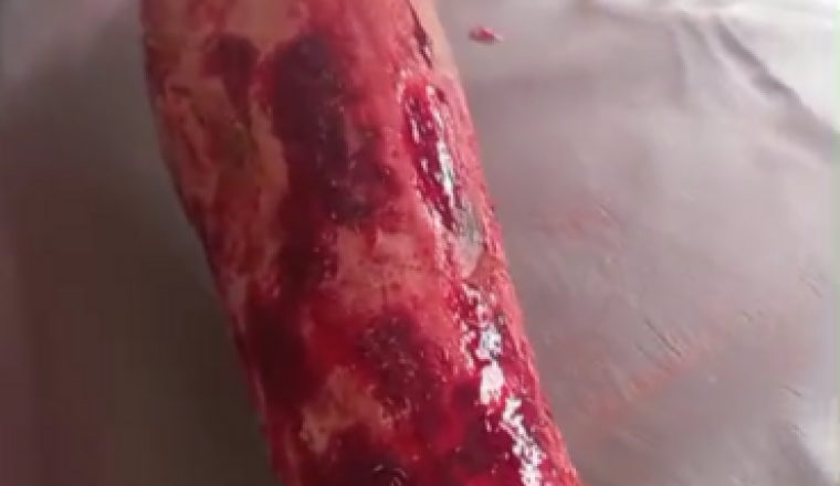 Petite fille brûlée au 3ème degrés
