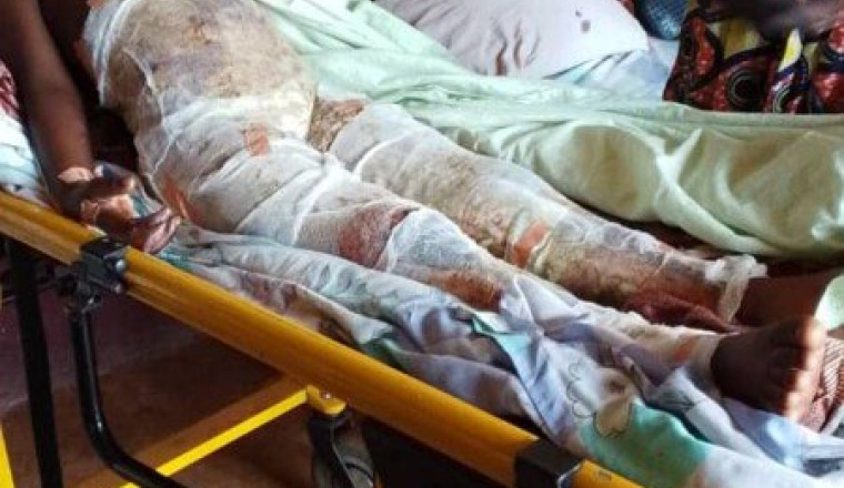 SOINS D’URGENCES FILLETTE GRAVEMENT BRÛLÉE