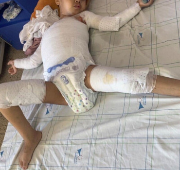 Soutien pour Meriem, 4 ans, gravement brûlée.