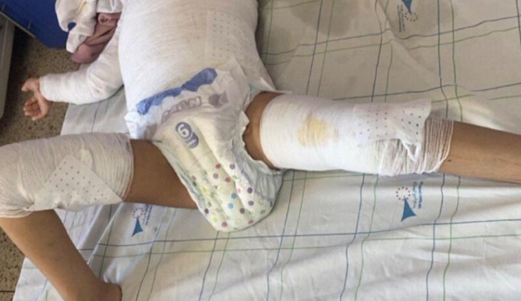 Soutien pour Meriem, 4 ans, gravement brûlée.