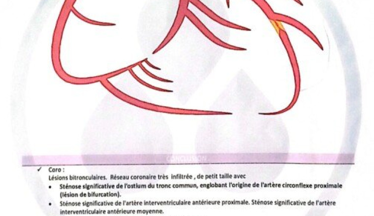 Frais chirurgie cardiaque urgente