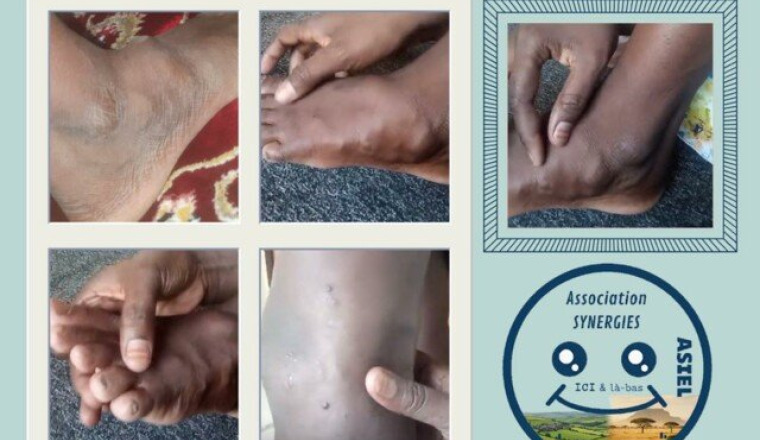 Appel au don pour les soins d'une fille de 13 ans
