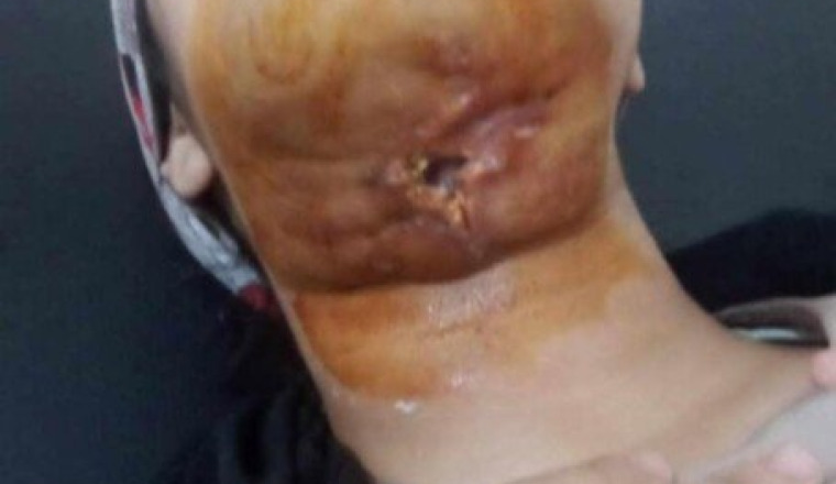 Urgence vital pour une jeune fille en Algérie