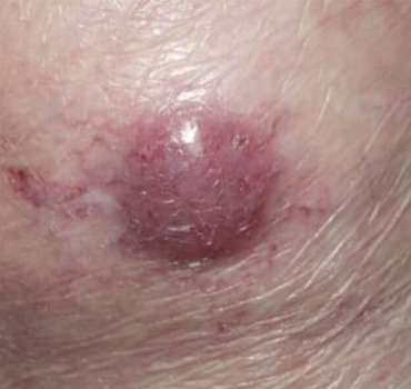 Ensemble, stoppons la progression du cancer.