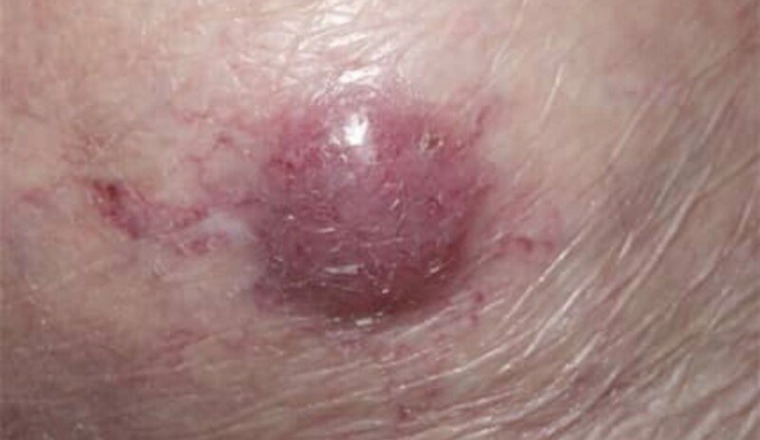 Ensemble, stoppons la progression du cancer.