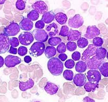 Lymphome Aiguë Lymphoblastique