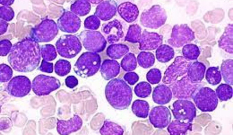 Lymphome Aiguë Lymphoblastique