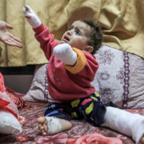 Des prothèses aux enfants amputés de GAZA 🆘🇵🇸