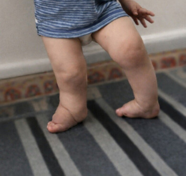 Aidons Outhmane, 2 ans, à marcher sans souffrir