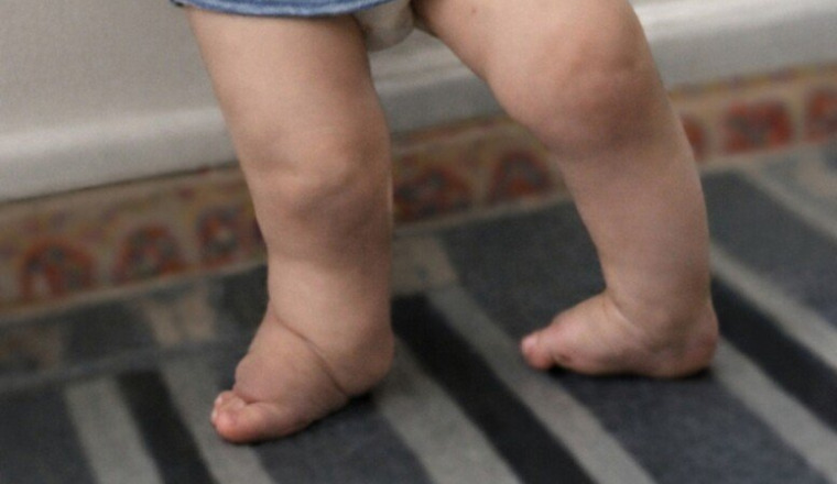 Aidons Outhmane, 2 ans, à marcher sans souffrir