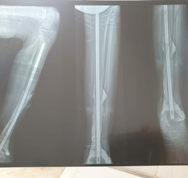 Aidons Khadija 15 ans à sauver sa jambe