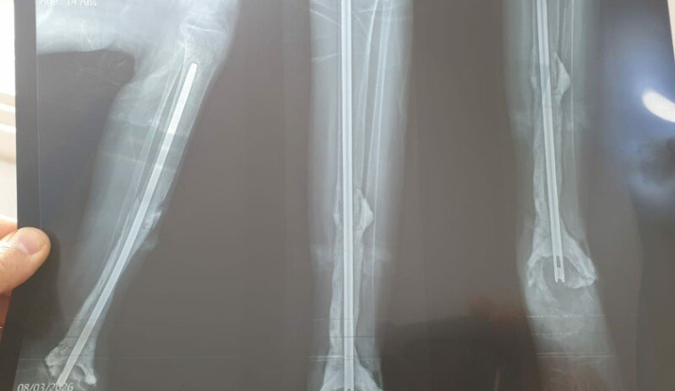 Aidons Khadija 15 ans à sauver sa jambe