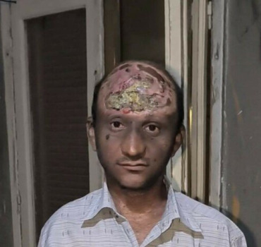 Aidons Mohamed atteint d'un cancer !
