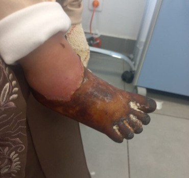 sauvons le pied de Hidaya petit ange de 3 ans